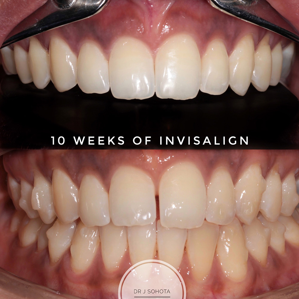 The Benefits of Having Straight Teeth with Invisalign Dental Treatment -  Medical / Health Blog